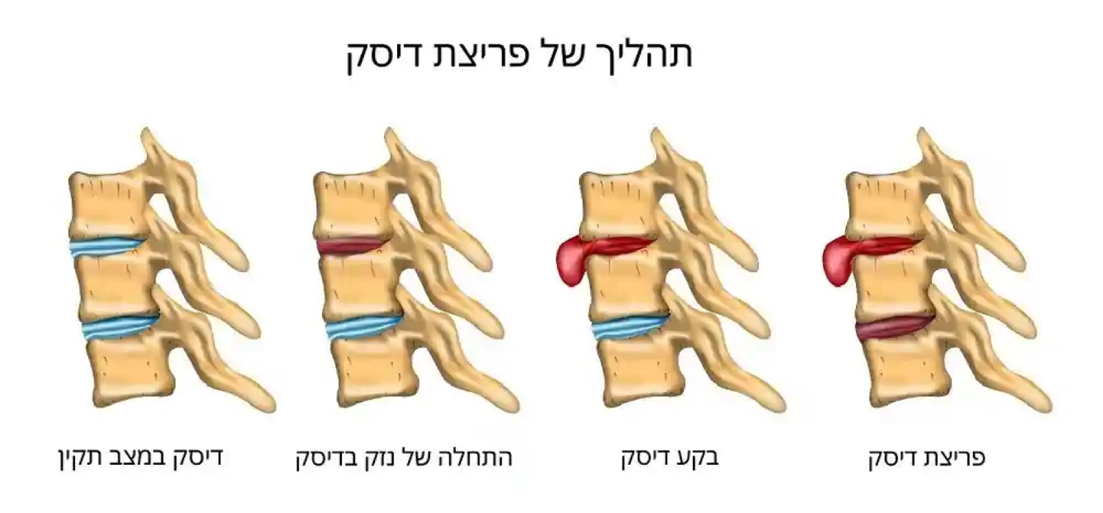 Let's talk about herniated discs